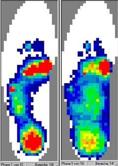 Analyse des pressions du pied rhumathoïde