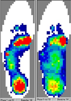 Analyse des pressions du pied rhumathoïde