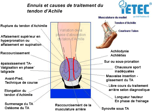 Ennuis et causes de traitement du tendon d'Achille