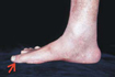déformation du pied rhumathoïde